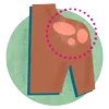 Psoriasis